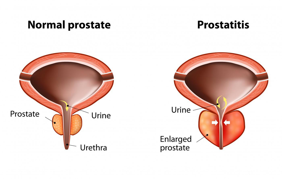 Normal prostate of a healthy man and inflammation of the prostate with prostatitis