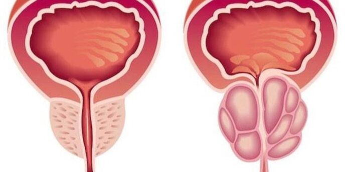 prostatitis